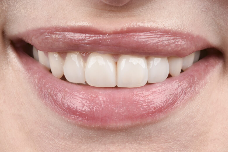 Diastema? Korekta metodą Flow Injection (Bonding)